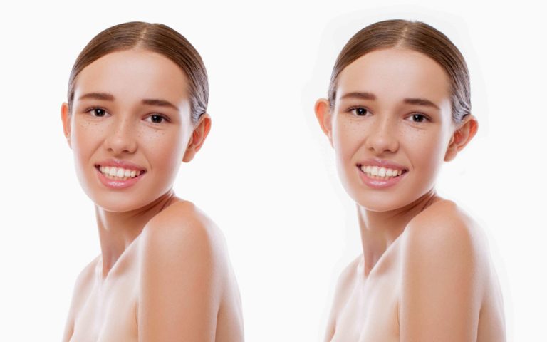 Ωτοπλαστική – Αποκαταστήστε το σχήμα των αυτιών με φυσικότητα και διακριτικότητα